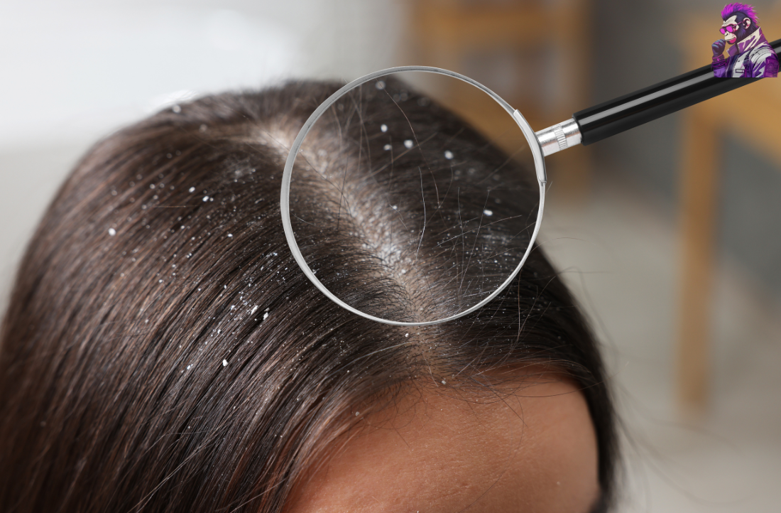 How to Treat Dry and Itchy Scalp in Children - Dandruff (Pityriasis Capitis)